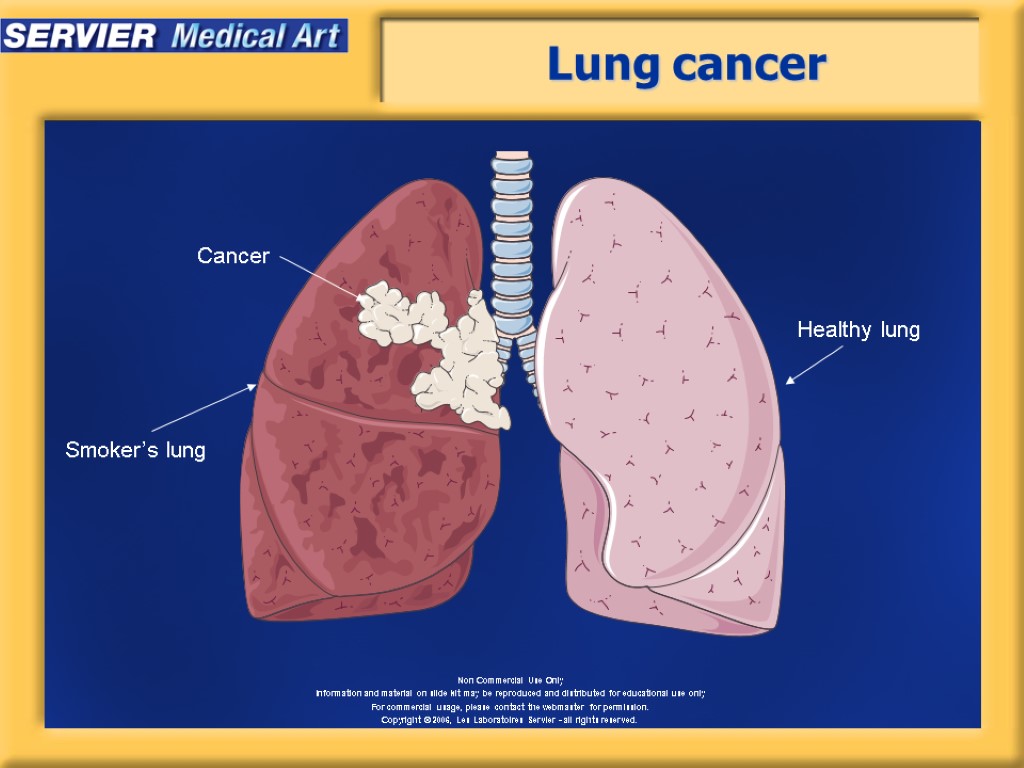 Lung cancer Healthy lung Smoker’s lung Cancer